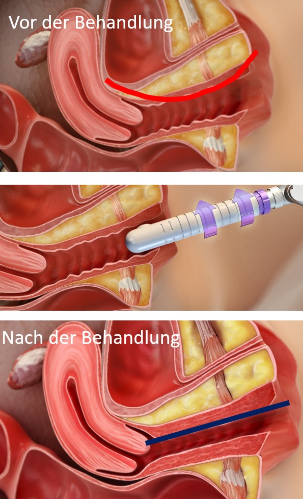 Vor, während und nach der Laserbehandlung.